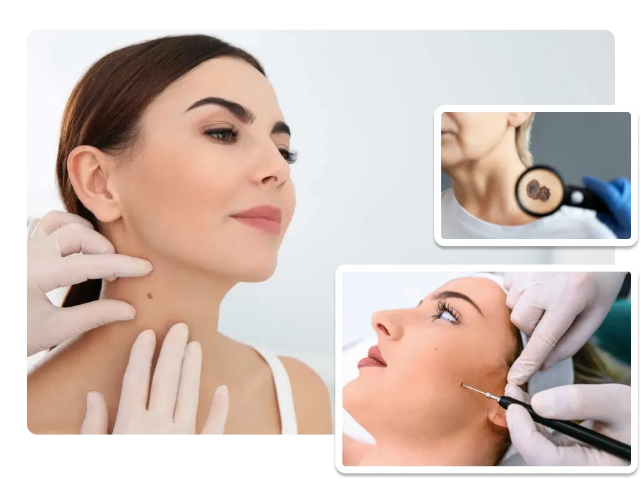 Birthmark Removal treatment_pic