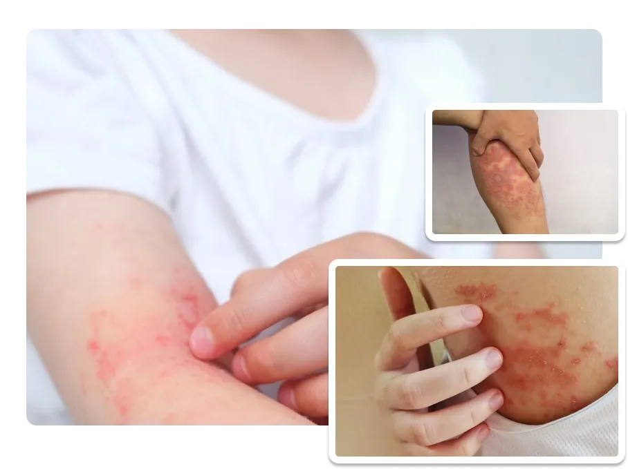 Dermatitis Treatment pic_1