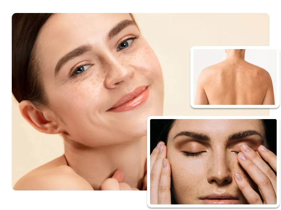 Freckle Removal treatments_pic