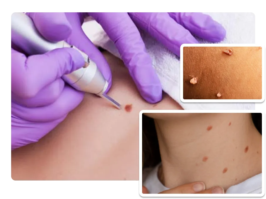 Genital warts Treatment_result