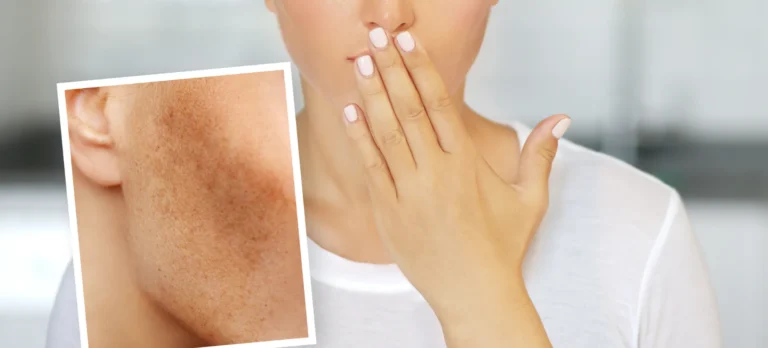 Illustration of facial pigmentation concerns
