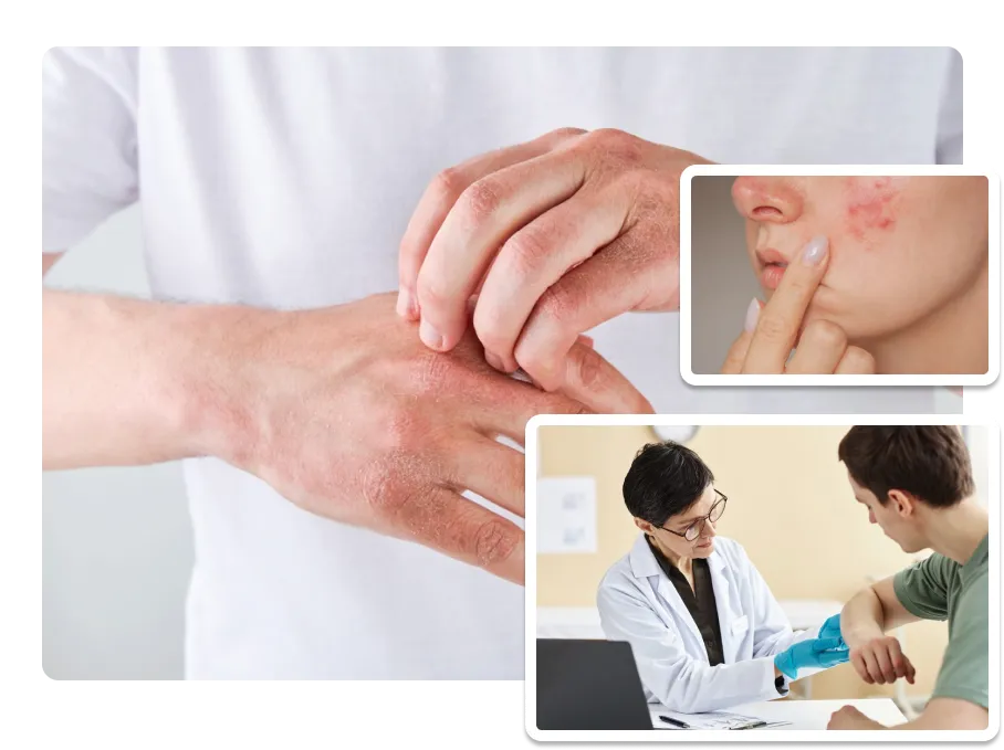 Psoriasis Treatment_image