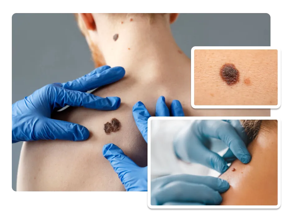 Seborrheic Keratosis Removal_result