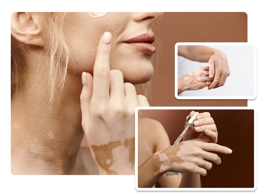 Vitiligo Treatment_result