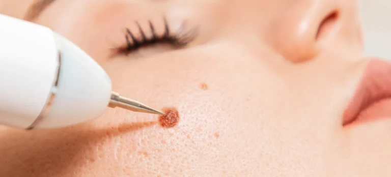 Clinic-provided wart removal illustration