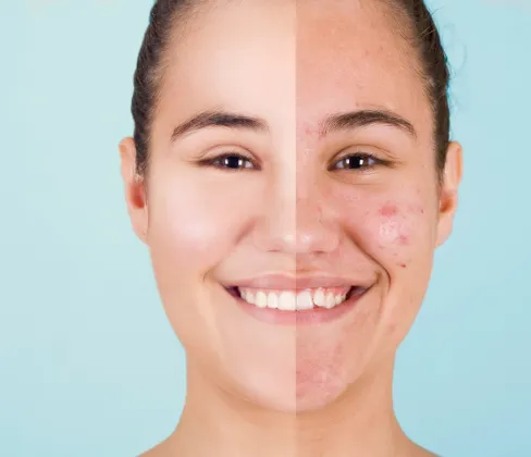 Advanced solutions to control breakouts, reduce scarring and improve skin texture.