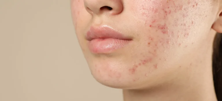 Clinic-provided acne treatment illustration