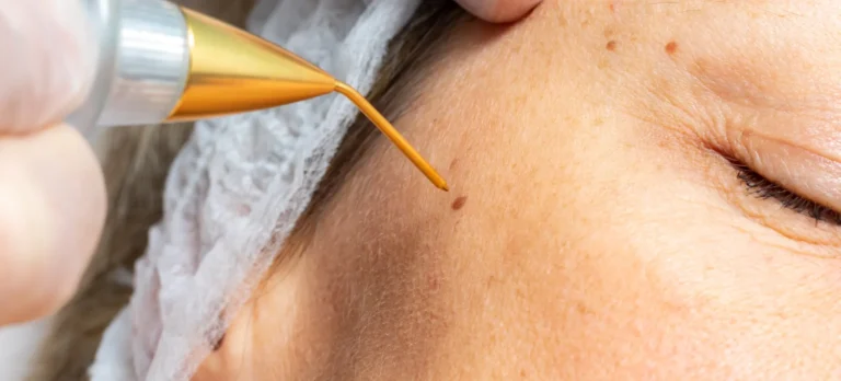 Clinic-provided melasma treatment illustration