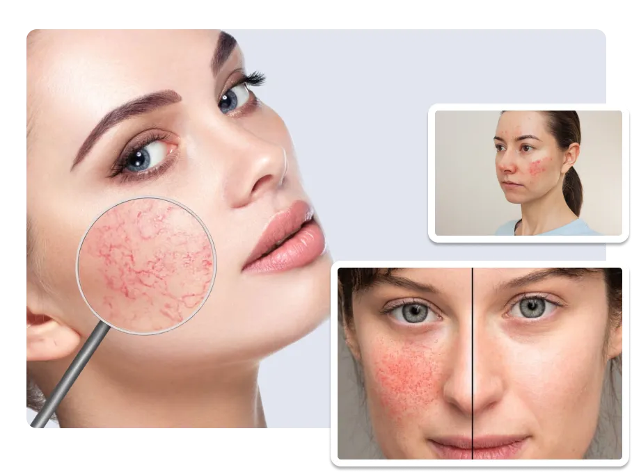 Rosacea Treatment_result