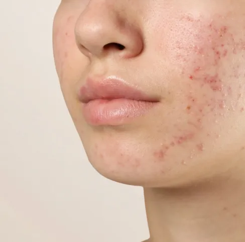 Gentle Chemical Peels