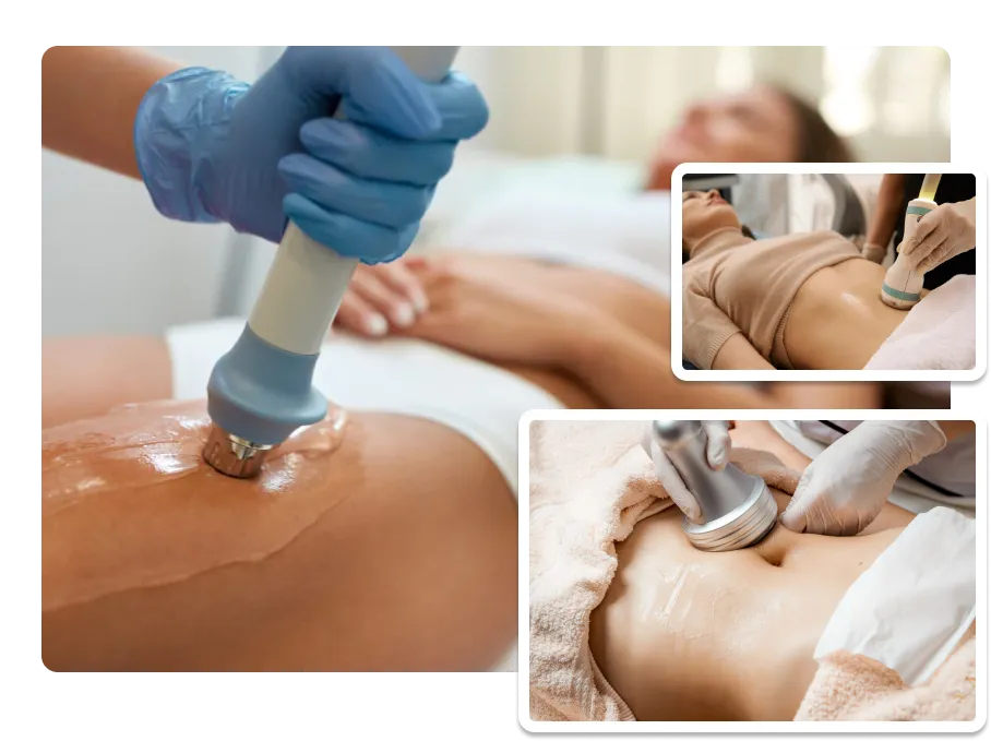 Body Contouring Treatments_result