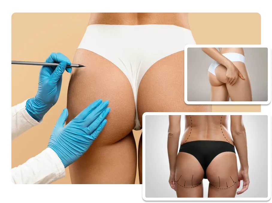 Brazilian Butt Lift_result