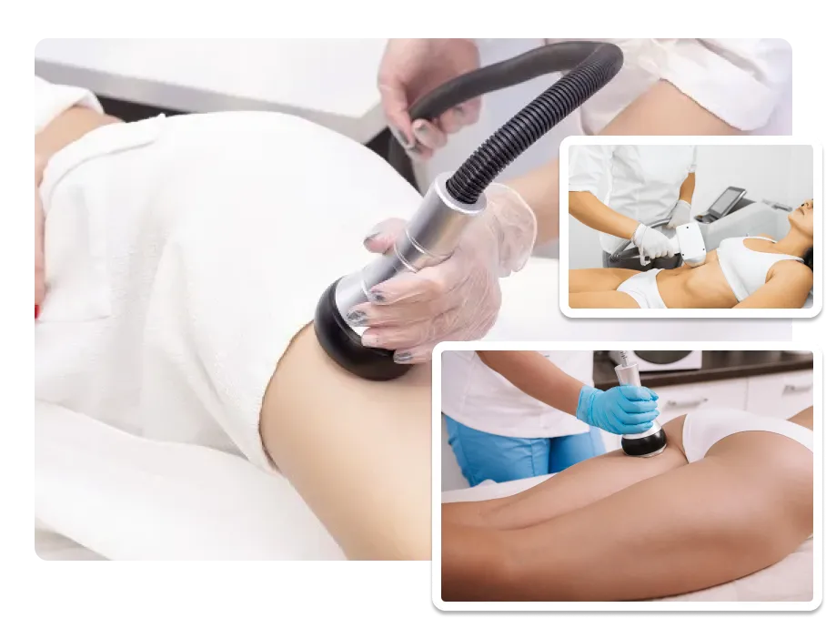 Cellulite Reduction Treatment_result