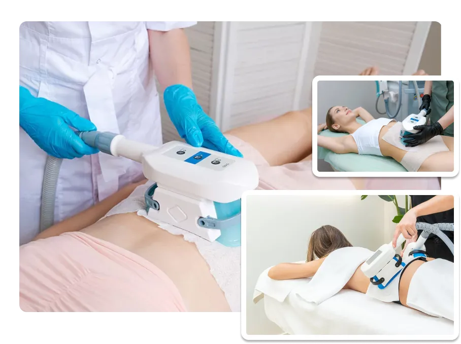 Cryolipolysis_result