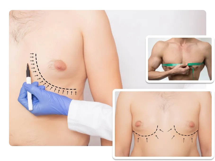 Gynecomastia Surgery_result