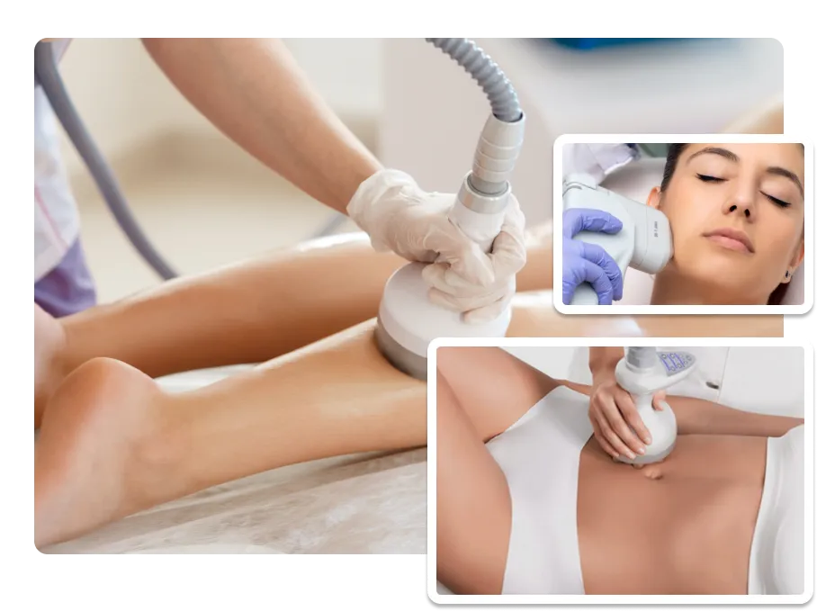 HIFU for Body Contouring_result