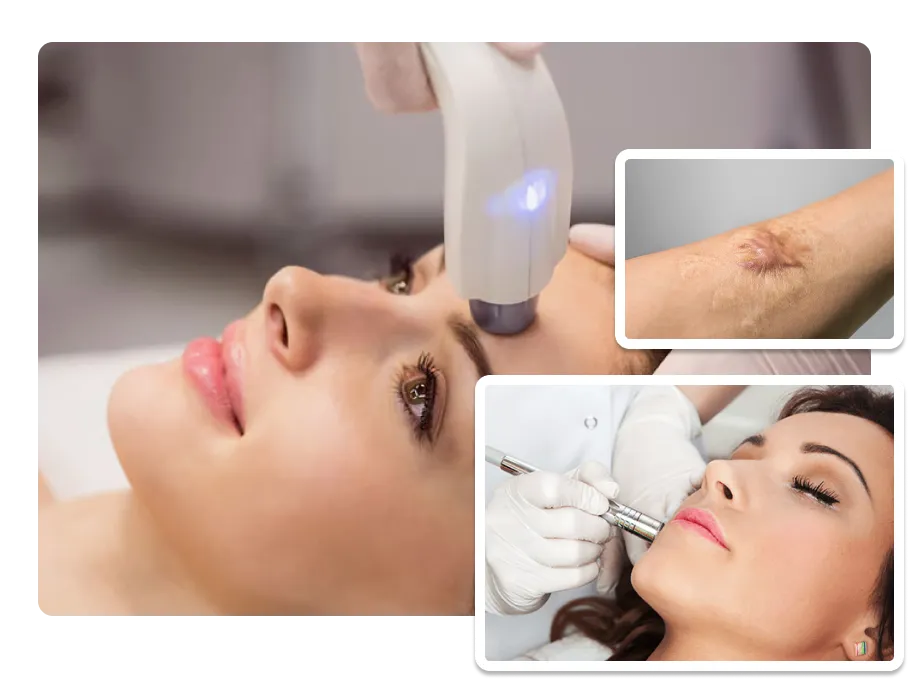 Laser Scar Revision_result