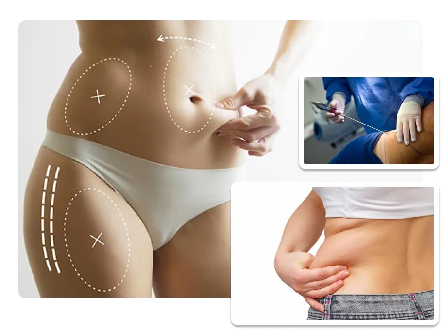 Liposuction_result