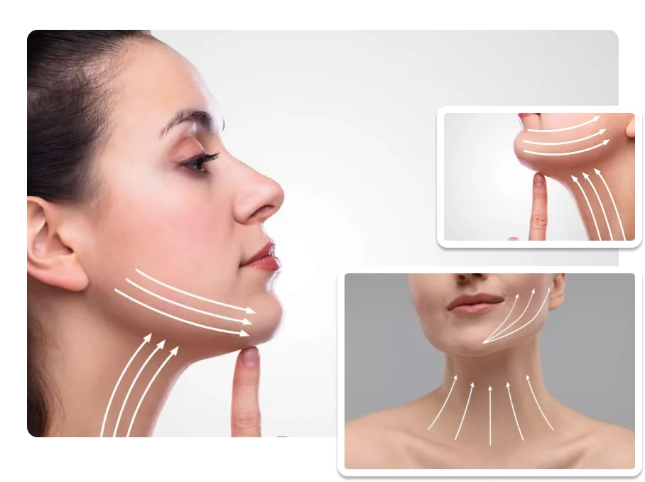 Neck Lift_result