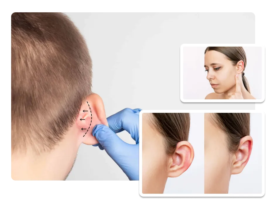 Otoplasty_result