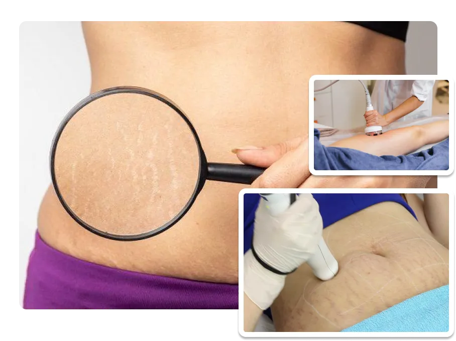 Stretch Mark Reduction_result