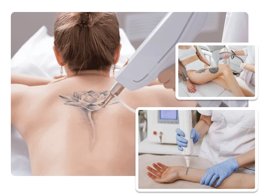 Tattoo Removal_result