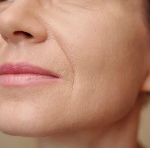 Nasolabial Folds