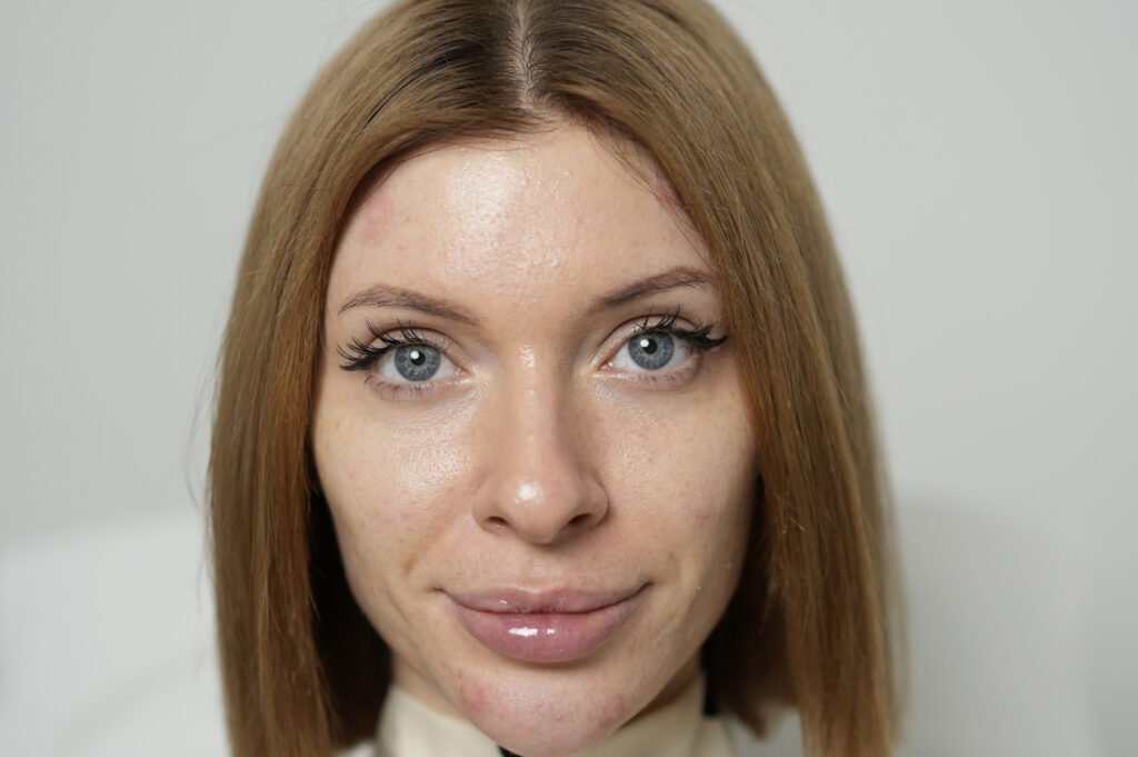 salmon dna injection before and after 