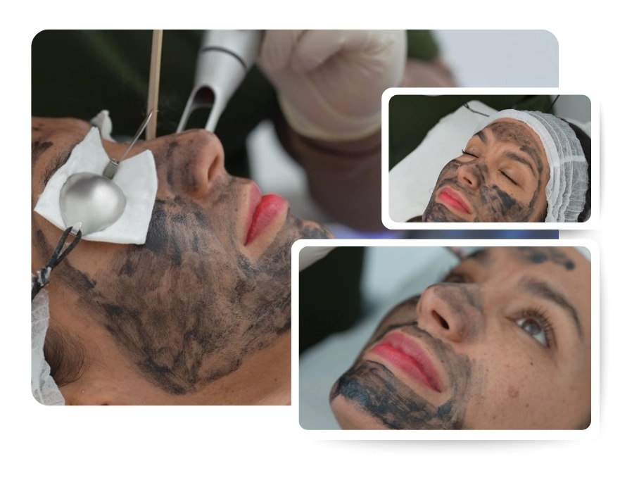 Carbon Laser Treatment_IMG