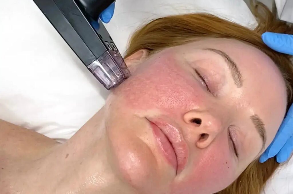 non surgical face lifting in jumeirah