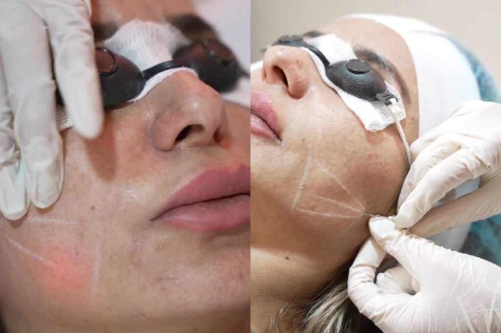 non surgical jawline lift jumeirah