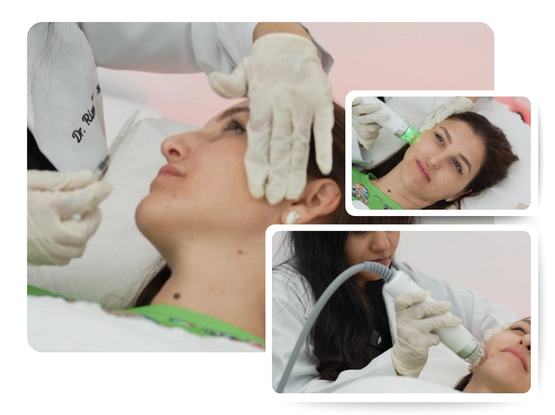 Rf Microneedling_IMG