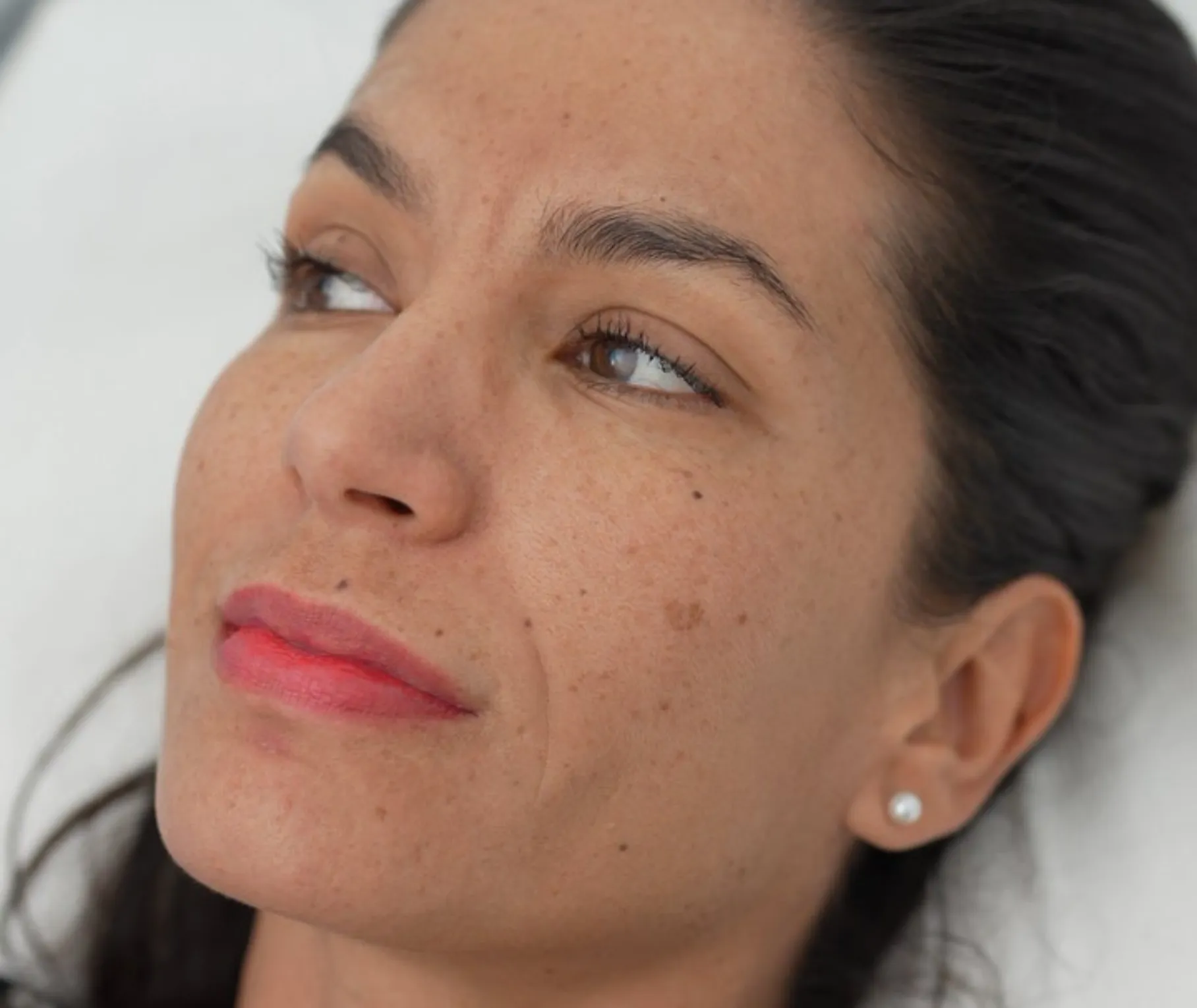 carbon laser treatments in uae_5