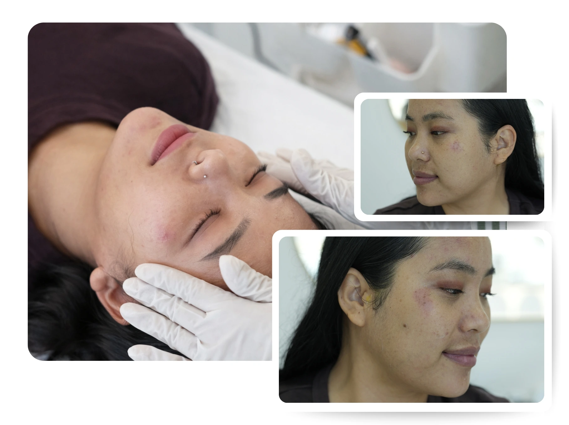 Chemical Peel Treatment in Jumeirah