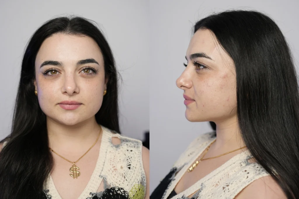 Profhilo treatment in jumeirah