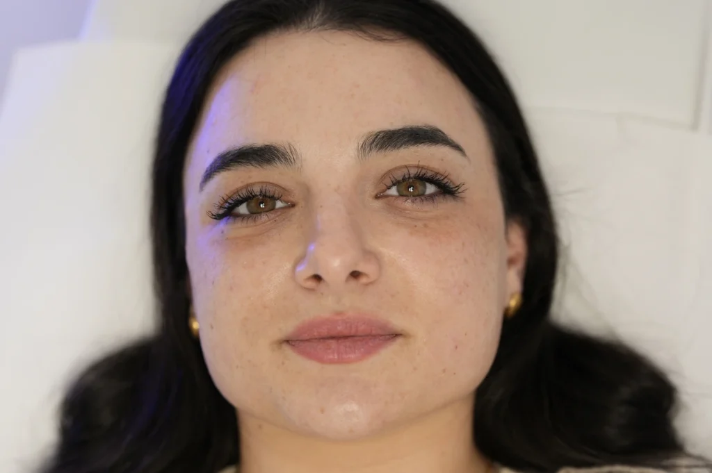 profhilo treatment near me 