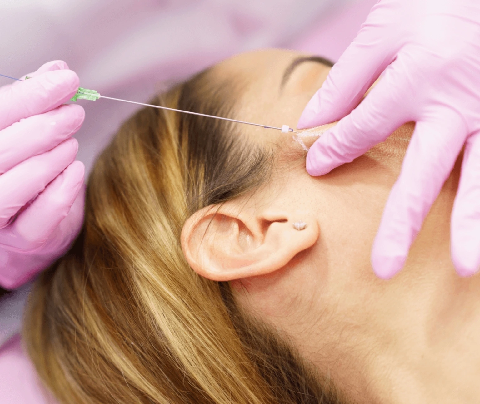 Thread lifting in jumeirah