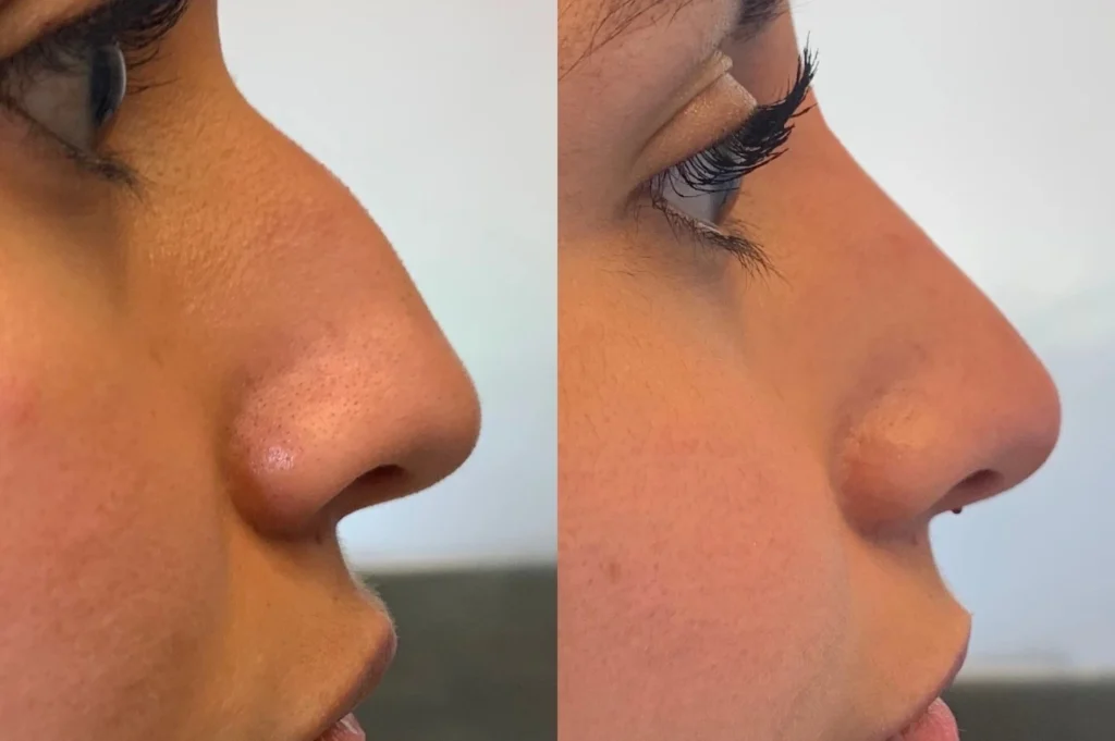 liquid rhinoplasty in jumeirah 