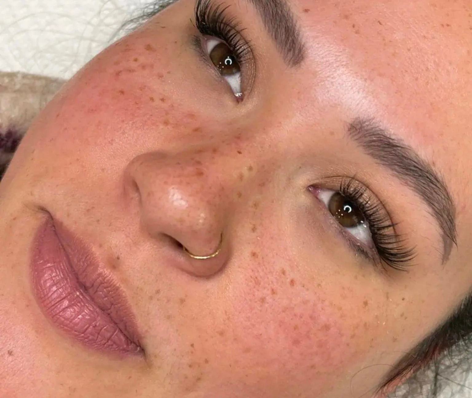 Freckles removal in jumeirah