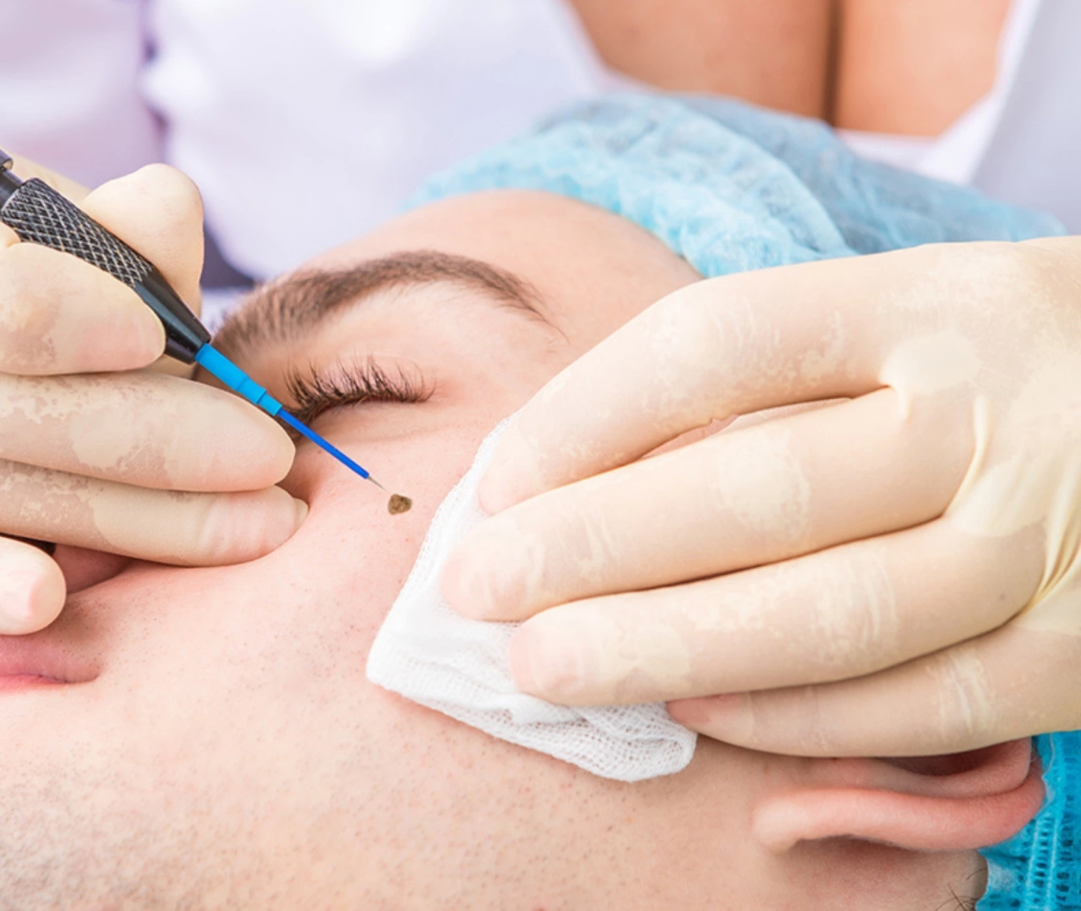 birthmark removal in jumeirah