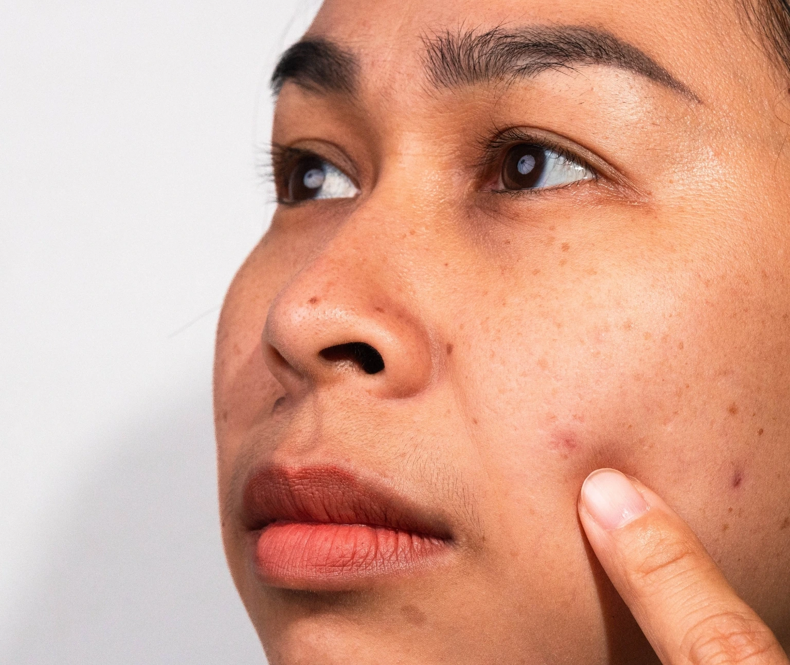 laser age spot removal in jumeirah