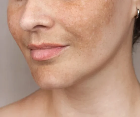 melasma treatment in jumeirah