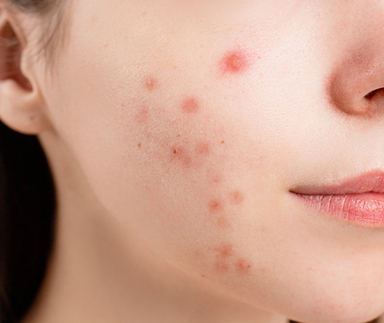 post acne erythema care in jumeirah