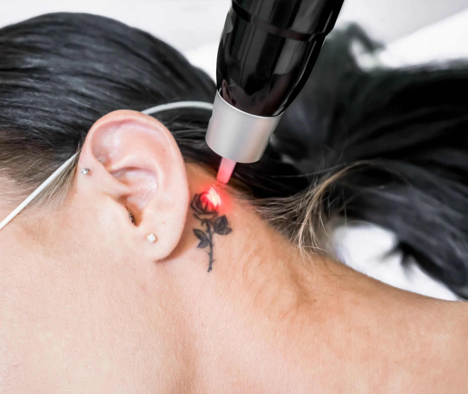 Tattoo removal in jumeirah