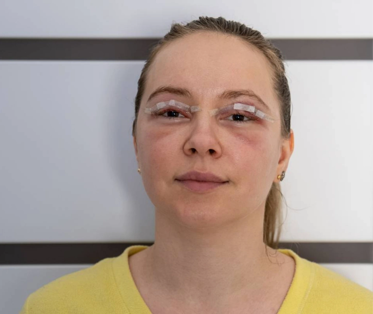 blepharoplasty in jumeirah
