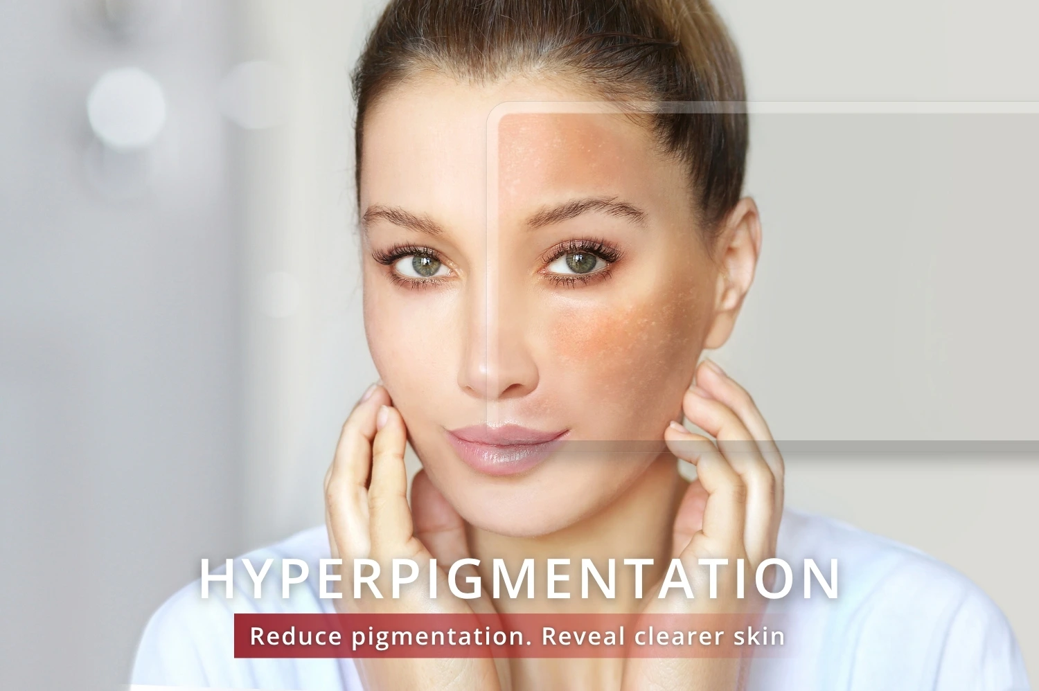 Hyperpigmentation treatment jumeirah